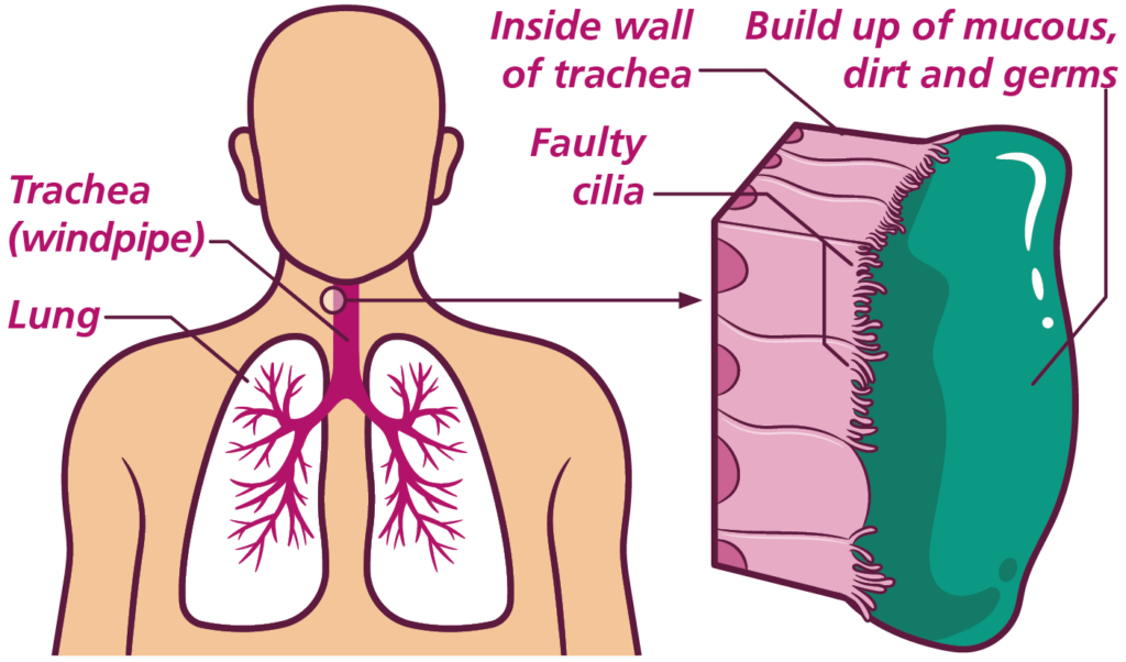 Illustration showing the windpipe and lungs. There is also a close up section of the inside wall of the windpipes showing how a build up of mucous, dirt and germs attaches to the faulty cilia.