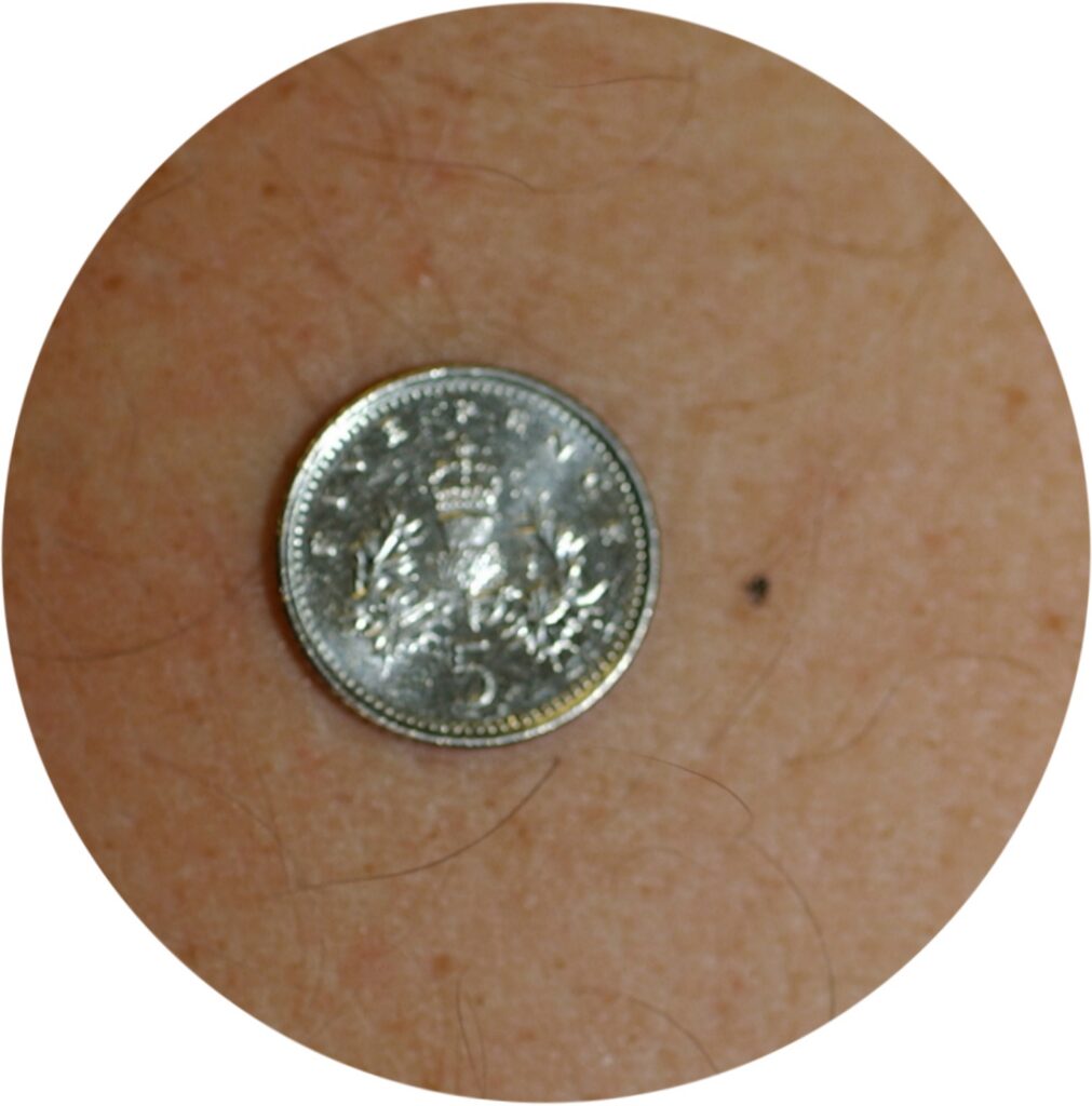 Photograph of a tattoo mark next to a 5 pence piece
