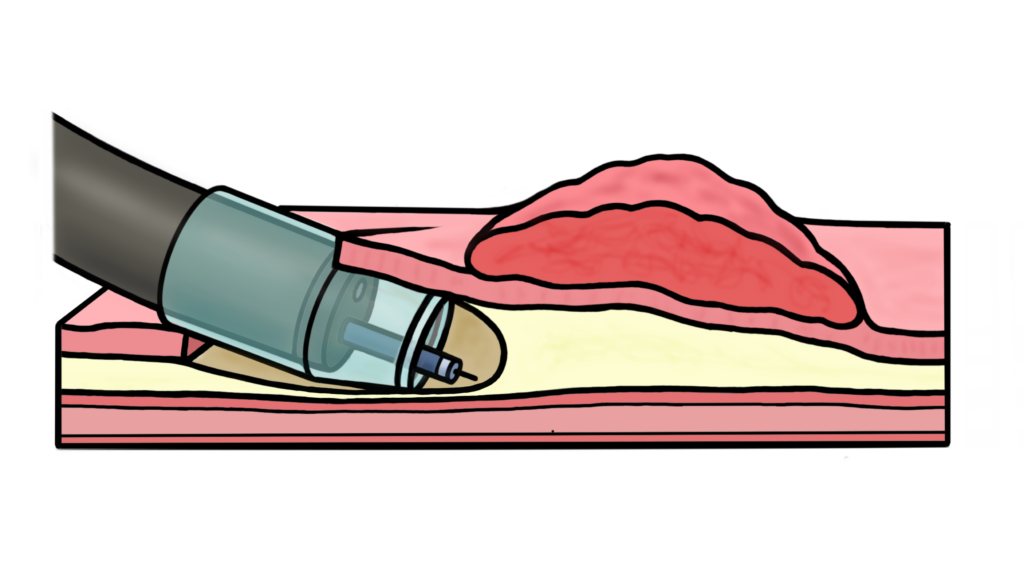 Diagram of an endoscopic submucosal dissection