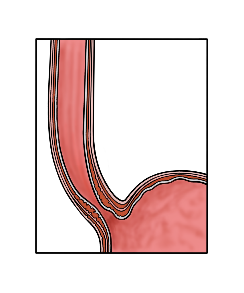 Diagram of a normal oesophagus