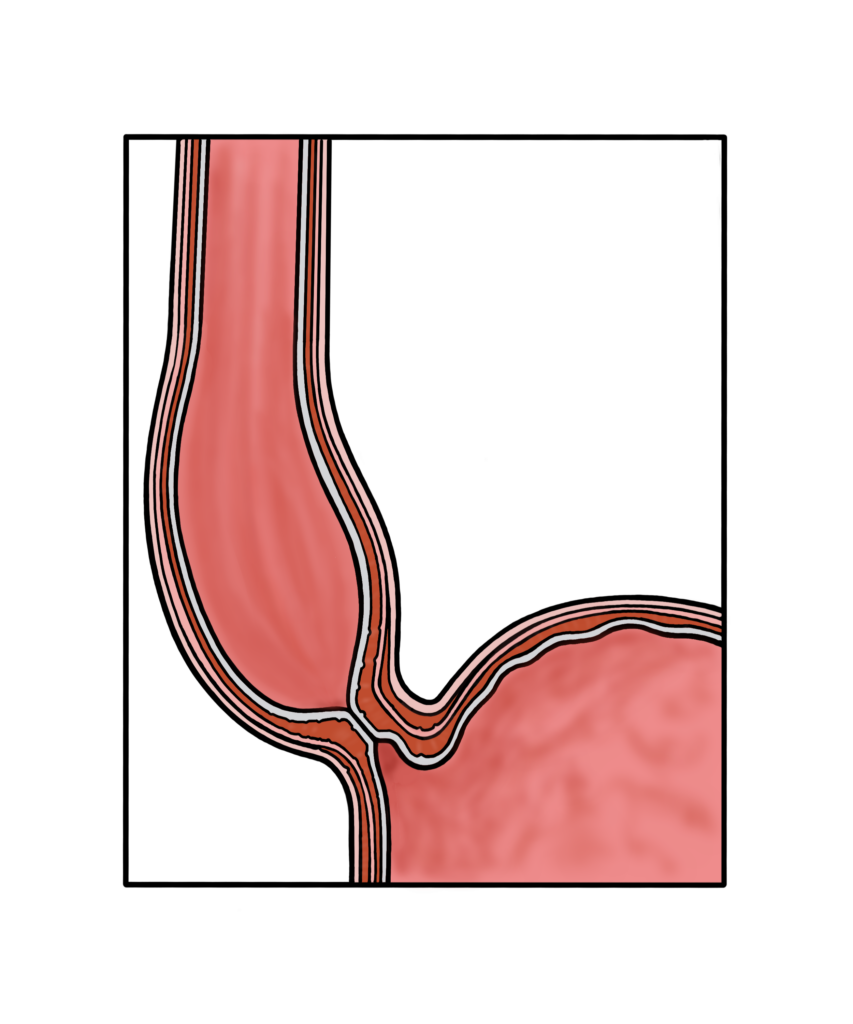 Diagram of a oesophagus with achalasia