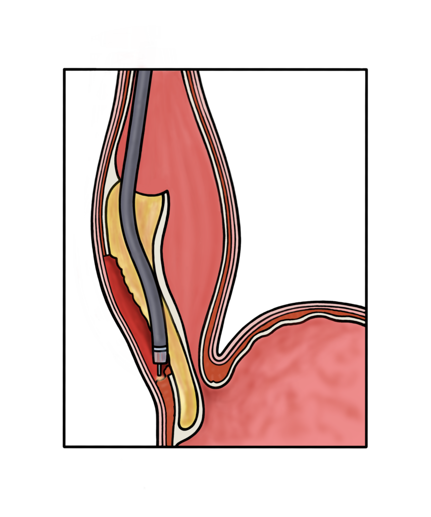 Diagram of Myotomy