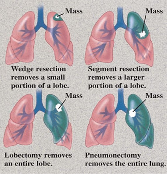 Diagram of lung procedures