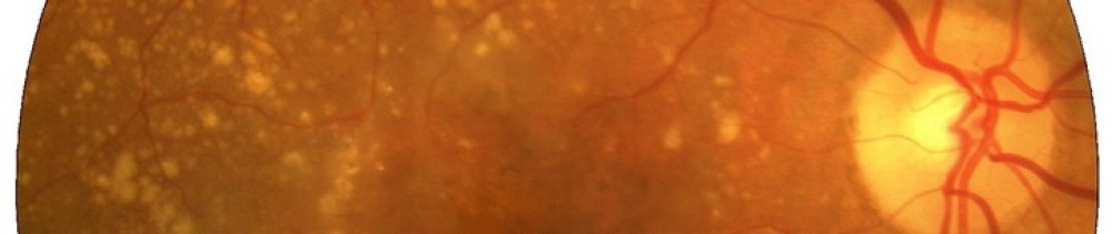 photo of retina