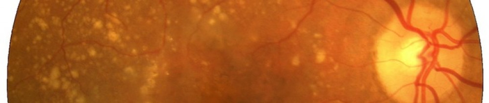 image of a retina