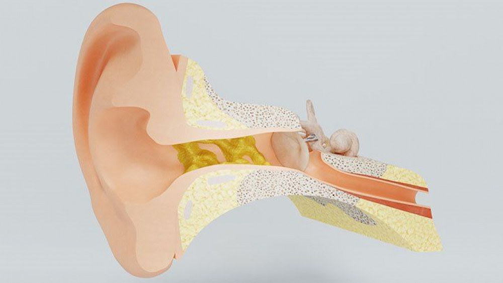 Diagram of earwax in the ear canal