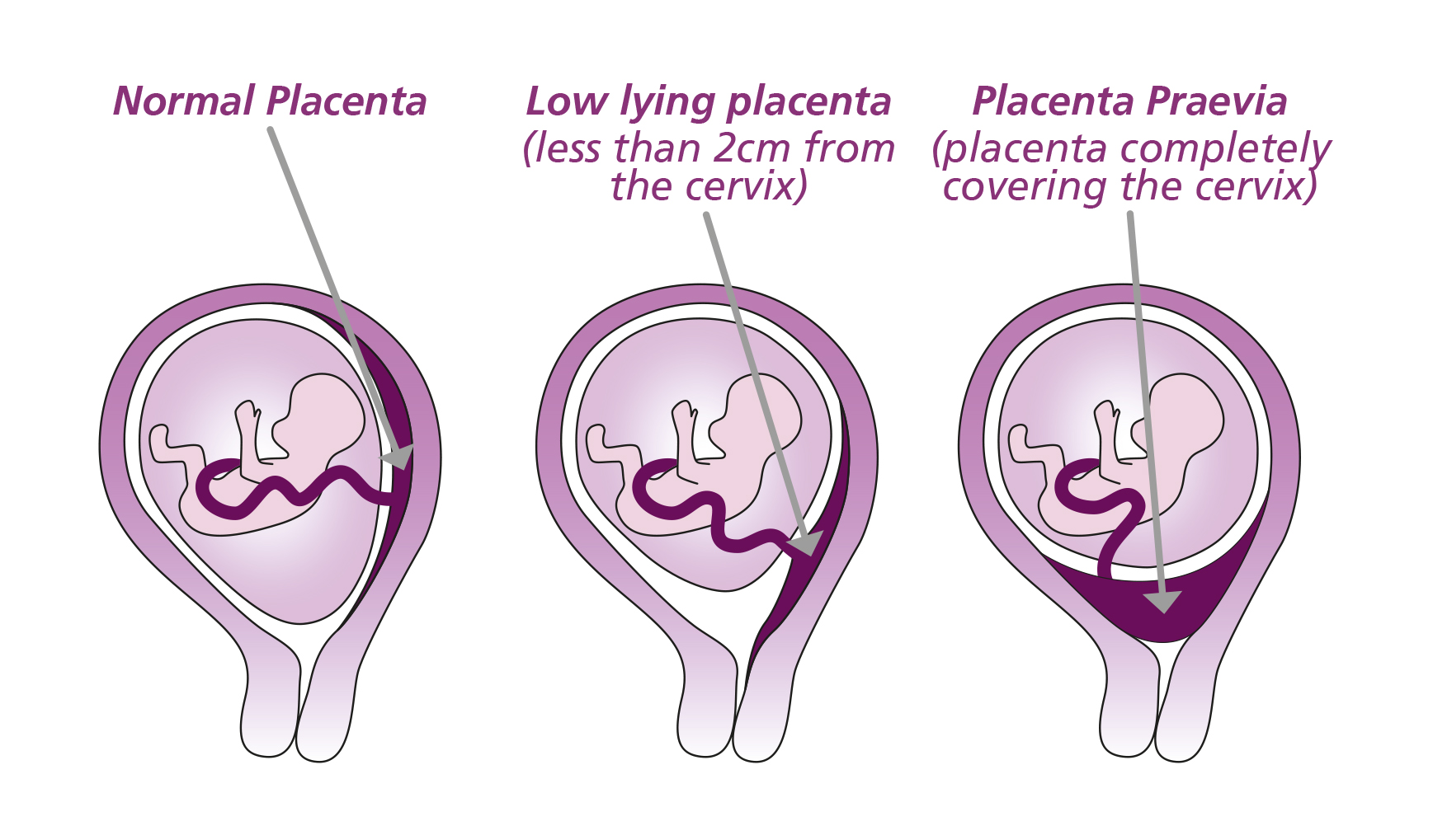 Placenta Praevia, Placenta Accreta and Vasa Praevia - Leeds ...
