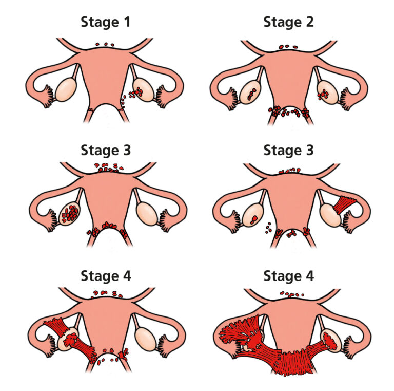 Endometriosis - Leeds Teaching Hospitals NHS Trust