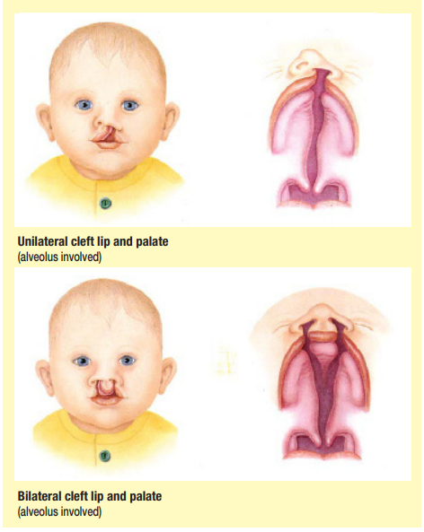 cleft lip and palate diagram