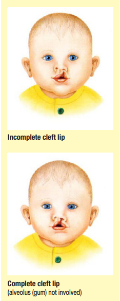 Cleft lip diagram