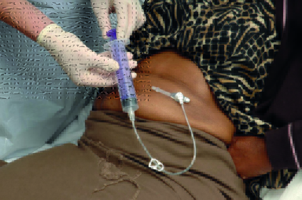 A photograph of nurse flushing gastrostomy tube.