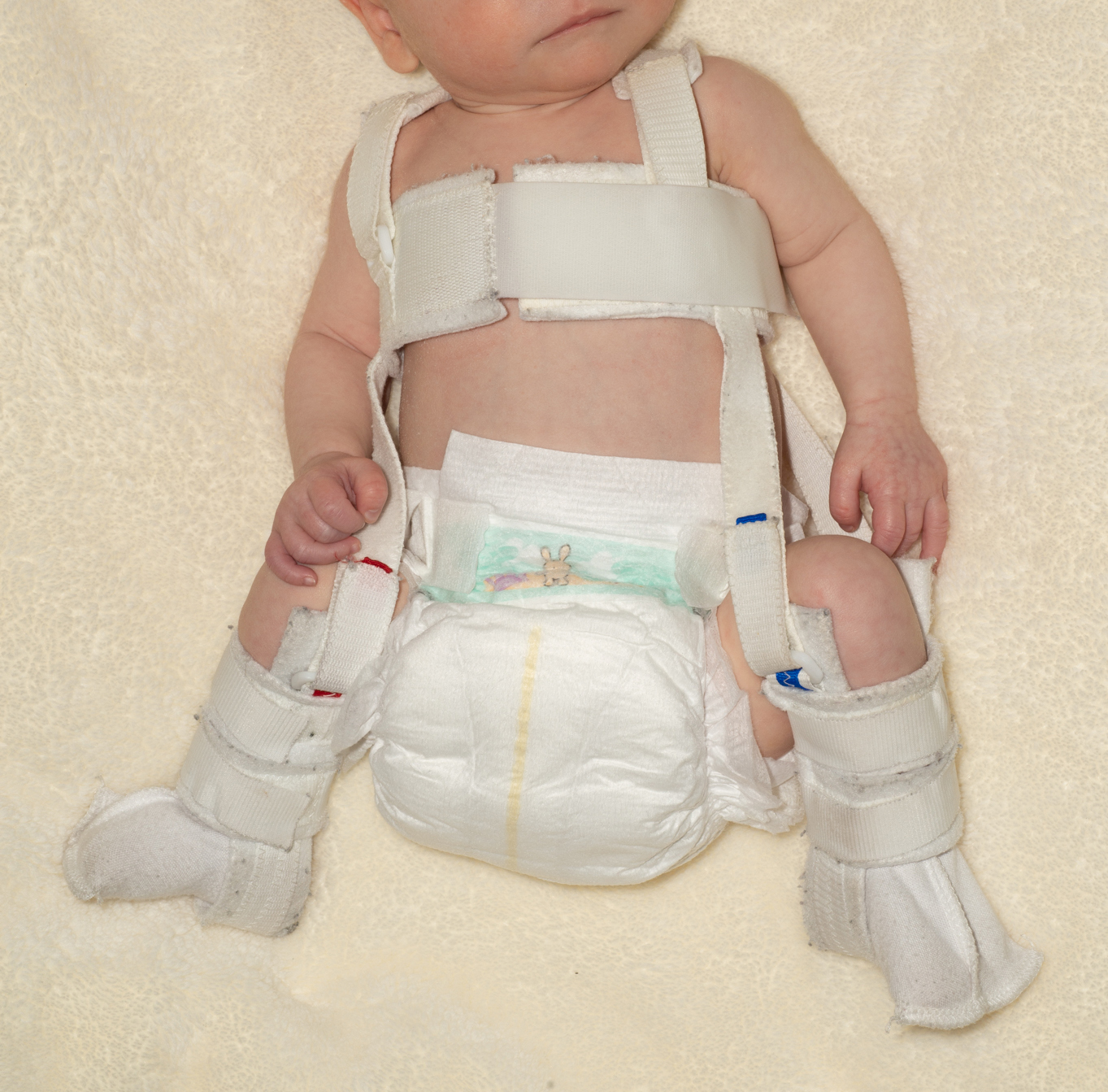 Image showing a Pavlik harness in use.
