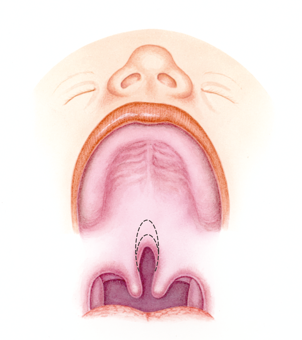 Cleft Palate - Leeds Teaching Hospitals NHS Trust