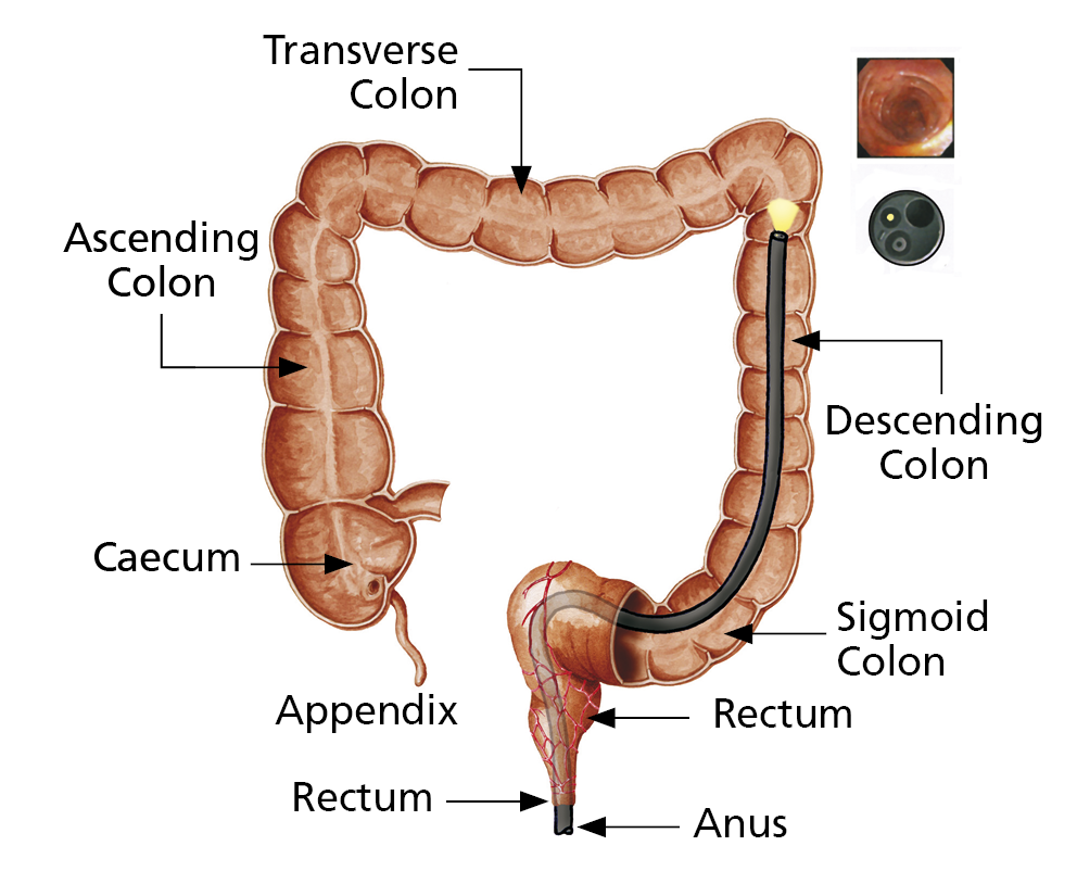 Illustration showing the different parts of the colon, and how the flexible tube from the camera is passed through the anus and up into the colon