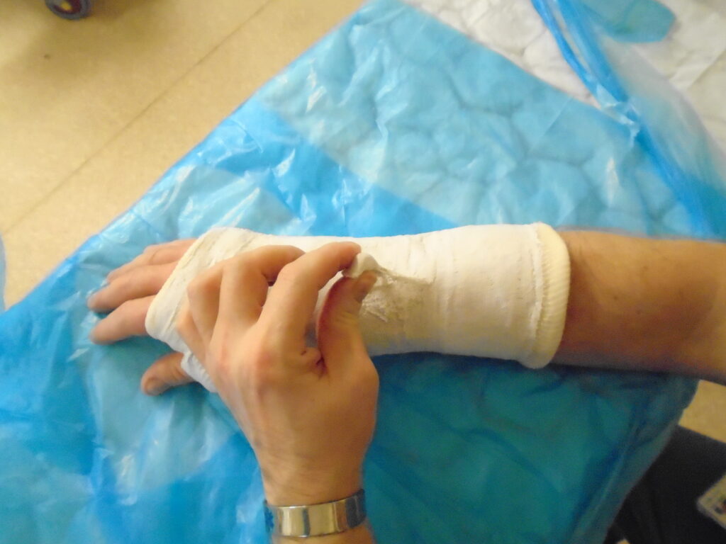 An image of the nobble of the cast being pulled to start the casts removal.