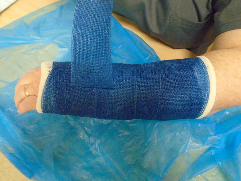 An image of a soft cast being unwound.