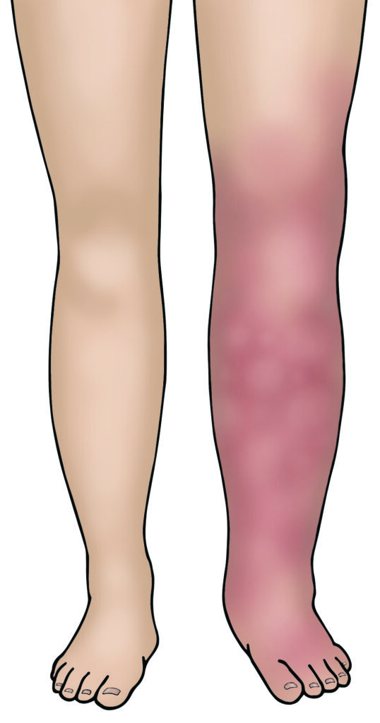 An illustration of a pair of legs showing one leg swollen and discoloured red, illustrating the possible signs and symptoms of deep vein thrombosis (DVT).