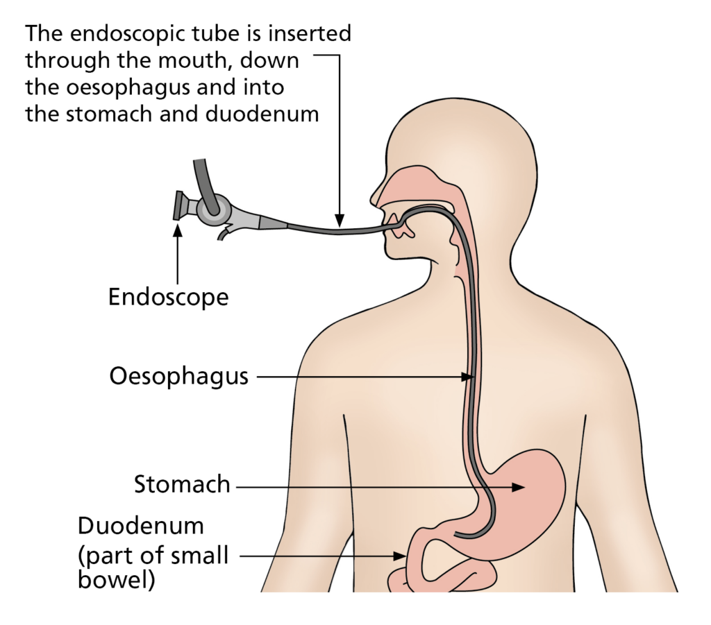 Illustration of the body showing the position of the Oesophagus, stomach and duodenum. It also shows the endoscopic tube being passed through the mouth down the oesophagus and into the stomach and duodenum
