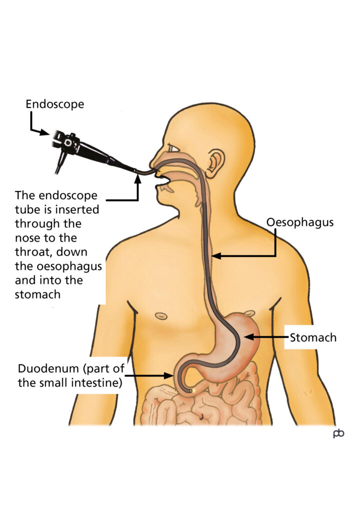 The picture shows and endoscope tube being inserted through the nose and throat, down the oesophagus and into the stomach. It then passes through the stomach and into the duodenum whcich is part of the small intestine. The doctor can then examine the lining  of the duodenum and perform the test.
