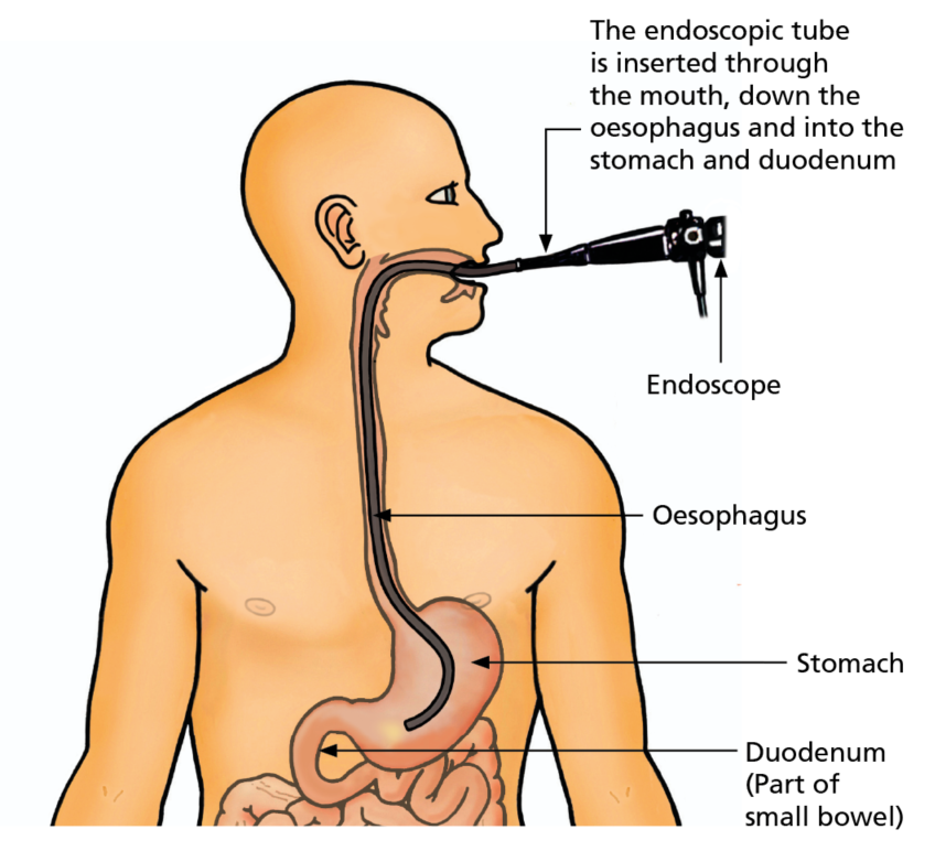 This image shows the endoscopic tube being inserted into the mouth. It then passes down the oesophagus (gullet) and into the stomach.