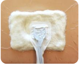 A photograph of the white PHMB gauze we use for Negative Pressure Wound Therapy and the suction port.