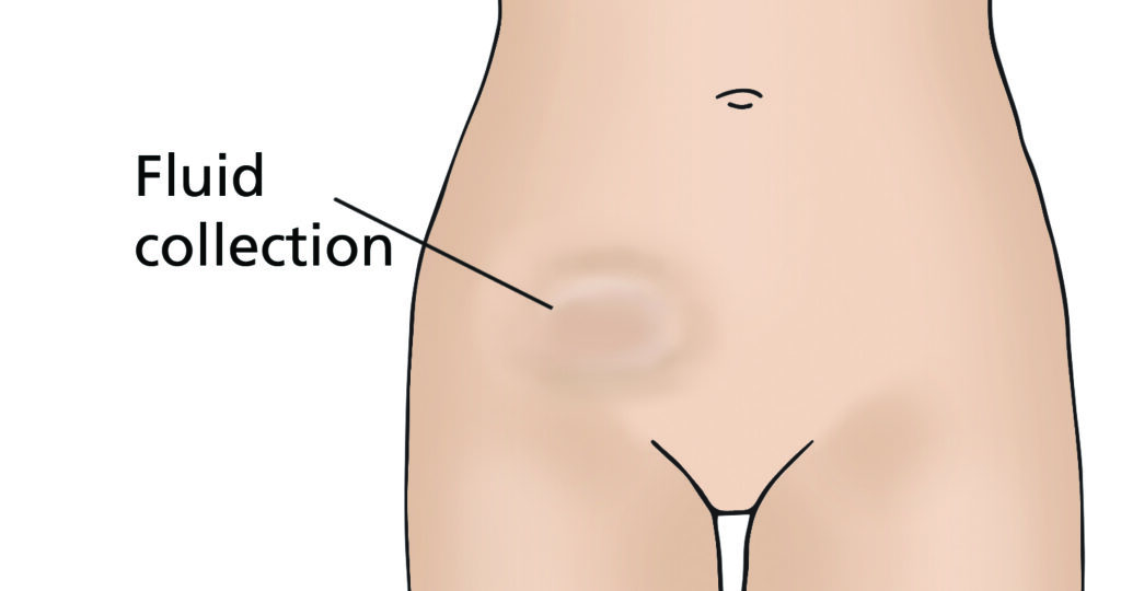 A diagram of pelvic area showing a circular bulge on lower left side where a lymphocyst may be. It is labelled fluid collection.