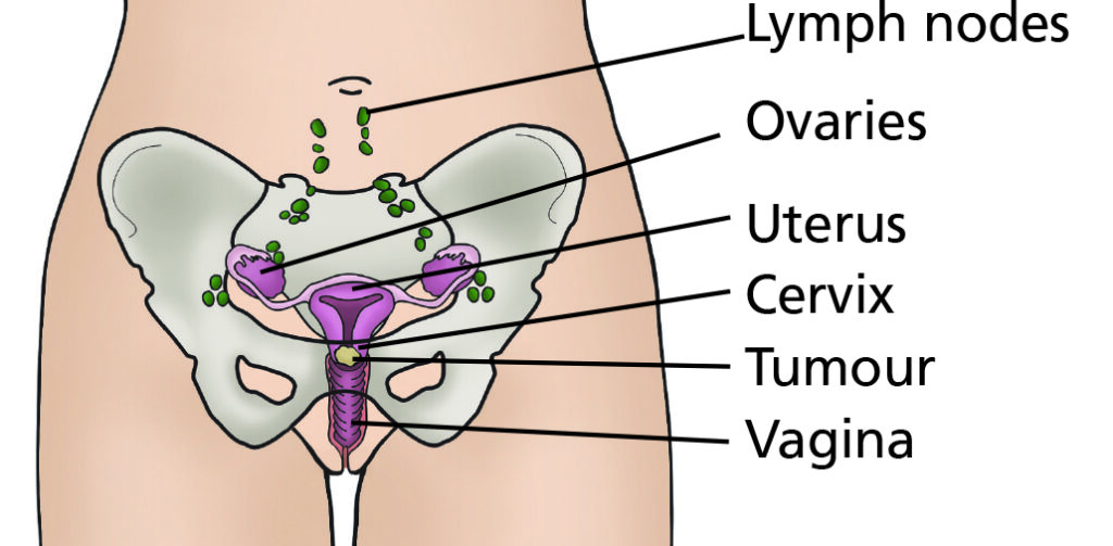 Diagram of pelvic area with labels for the cervix, tumour, vagina, uterus, ovaries and lymph nodes.