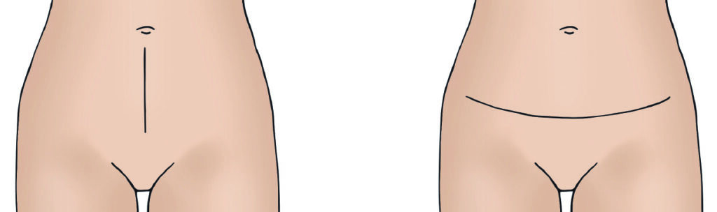 Two diagrams of pelvic area. Image on the left shows a vertical incision line from belly button down to pubic area. Image on the right shows a horizontal 'bikini line' incision line.
