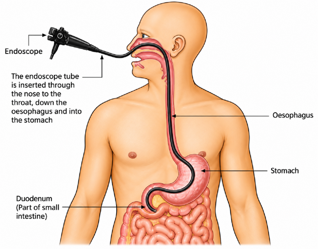 Medical illustration showing an endoscope inserted through the nose, down the throat and oesophagus, into the stomach and duodenum. Labels identify the endoscope, oesophagus, stomach, and duodenum (part of the small intestine).