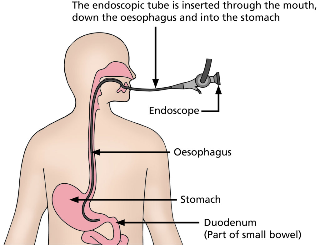 An illustration showing an Endoscopic Ultrasound. An endoscopic tube is inserted through the mouth, down the oesophagus and into the stomach.