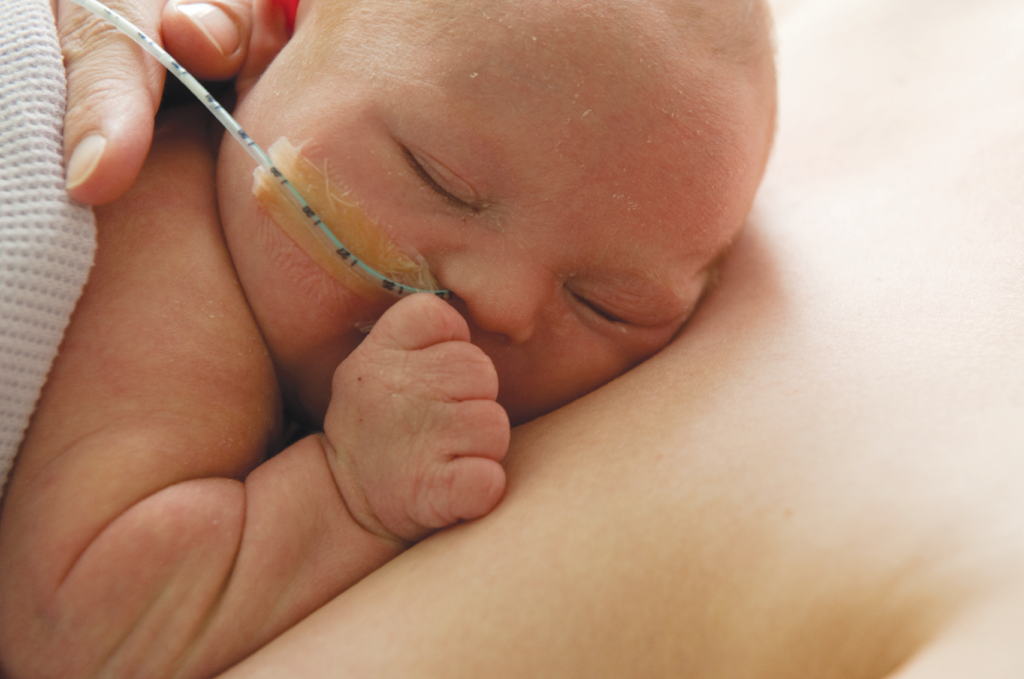 Close-up of a sleeping baby with a feeding tube, resting with one hand near their face.