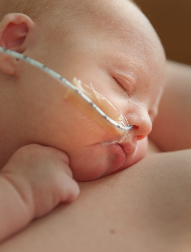 Close-up of a sleeping baby with a feeding tube resting on an adult's hand.