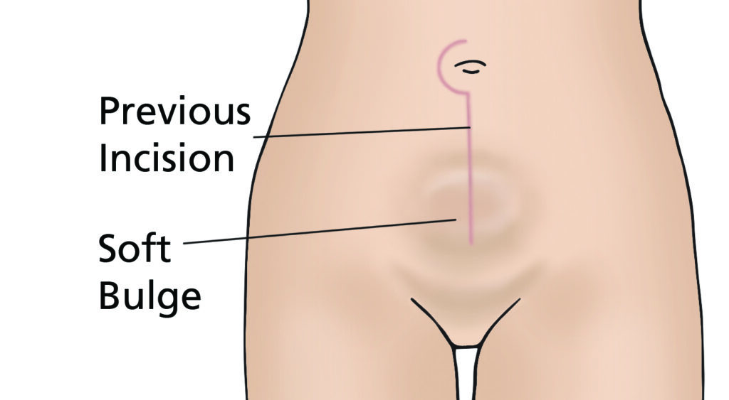 A diagram of pelvic area showing a circular bulge beneath the belly button and over the wound. It has labels for previous incision and soft bulge.
