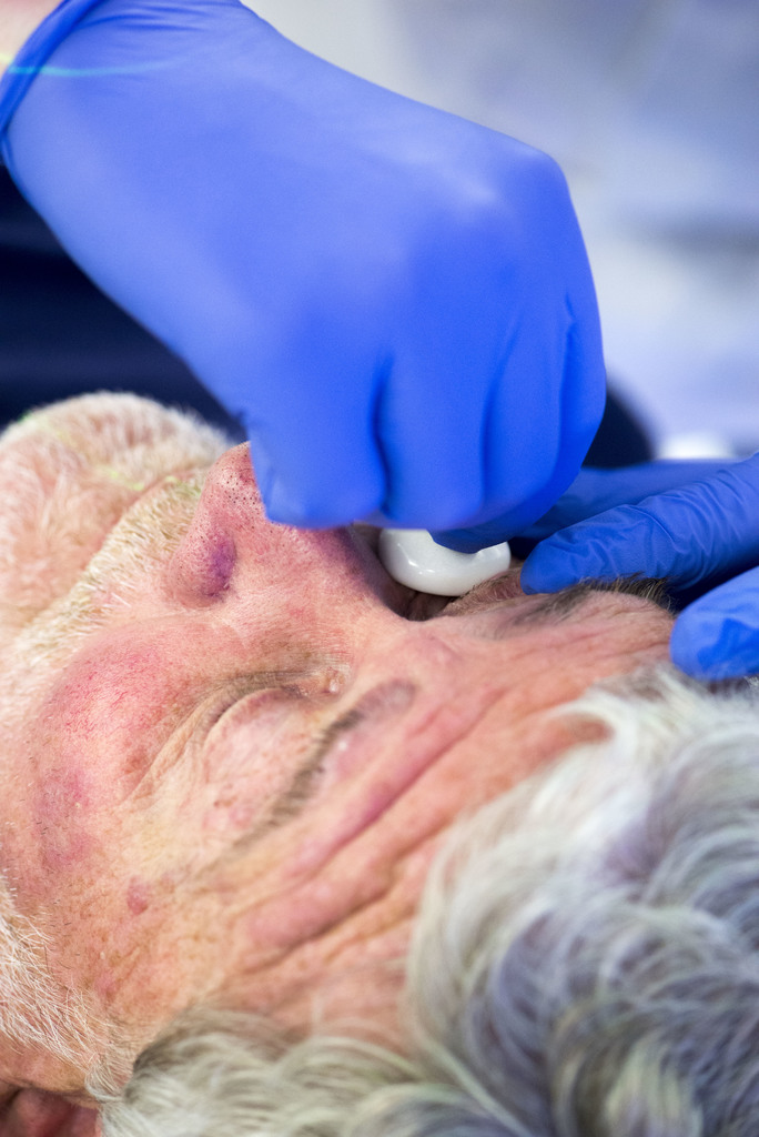 Photograph showing a clinician inserting an eye shield.