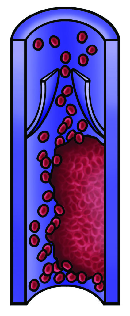 An illustration showing a clot forming inside a deep vein and partially blocking blood flow.