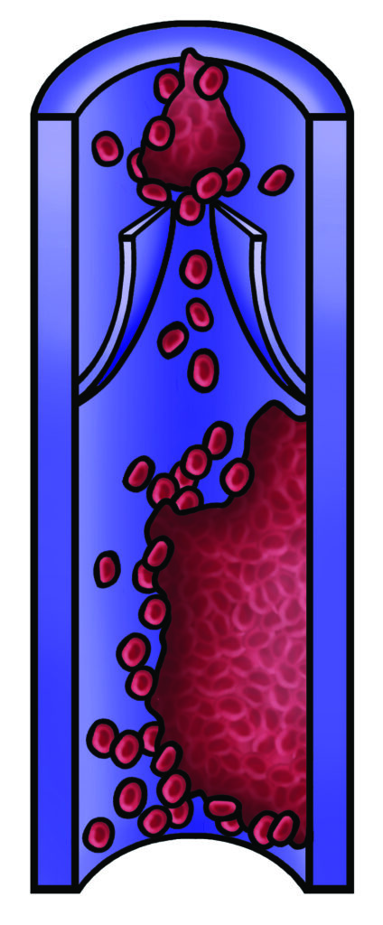 Illustration of blood vessels showing a clot that has partially broken away