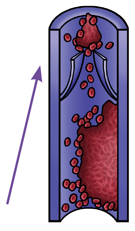 An illustration showing part of the clot has broken away and travelling through the bloodstream.