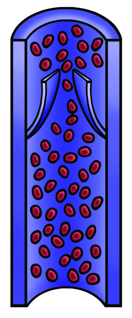 An illustration showing normal blood flow through a vein.
