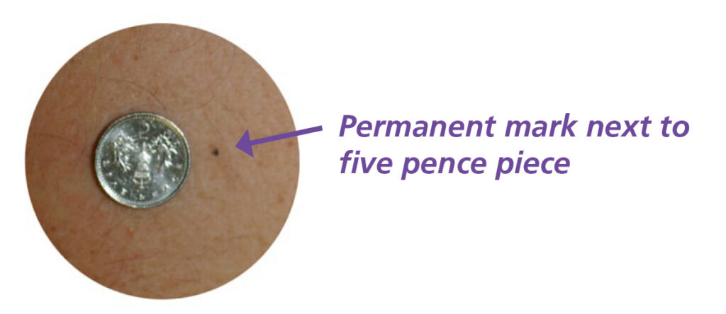 Permanent ink mark next to a five pence piece.
