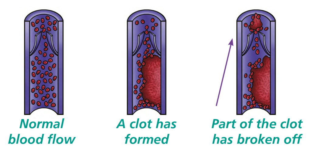 Illustration of a blood clot inside a blood vessel.
Three simplified medical illustrations showing the progression of a blood clot. The first shows normal blood flow through a vein. The second shows a blood clot forming inside a deep vein and partially blocking blood flow. The third shows part of the clot breaking away and travelling through the bloodstream.