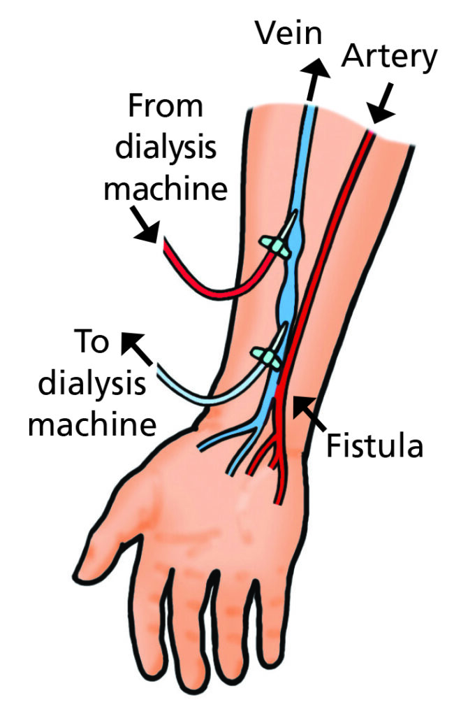 Illustration which shows a fistula being connected to the machine using two needles.
