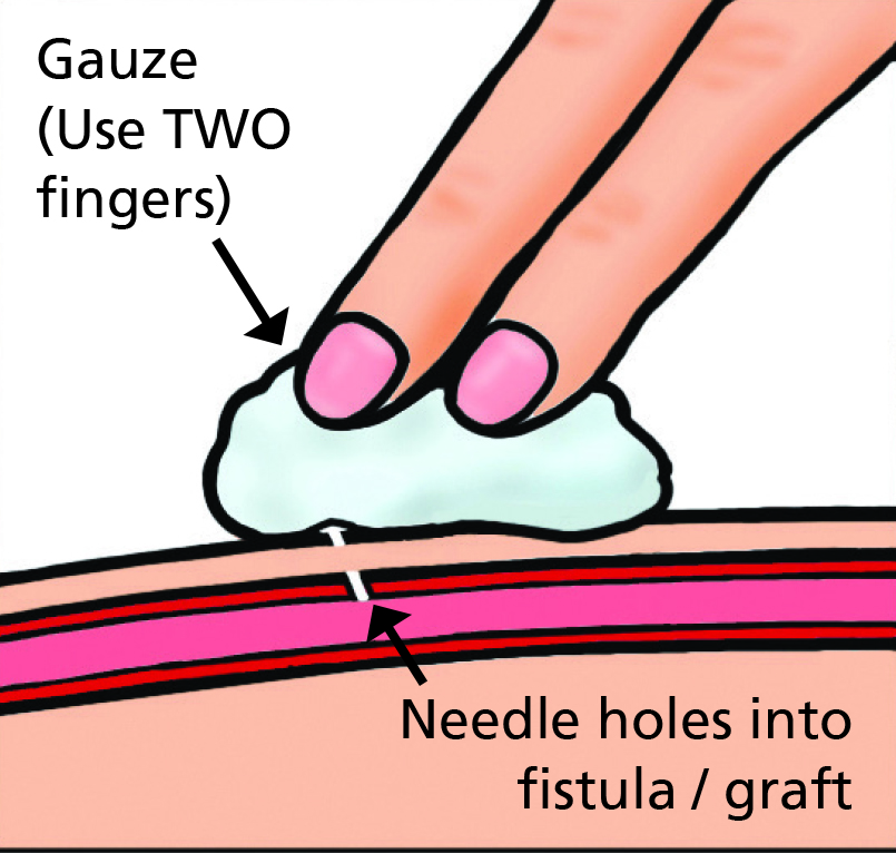Illustration which shows how/where to press on potential bleeding sites.