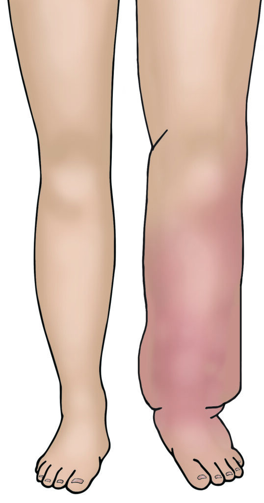 Image of a pair of legs with a very swollen and reddened right leg.