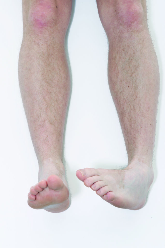 Photograph of a persons legs with one foot relaxed and the other stretched inwards