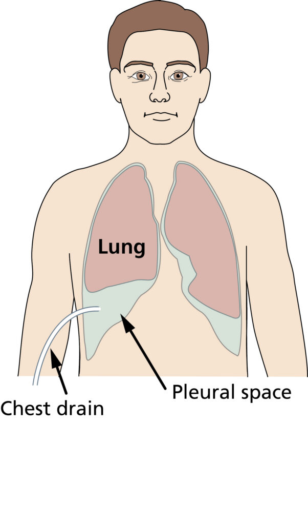 Diagram of a person showing the lung, pleural space and chest drain