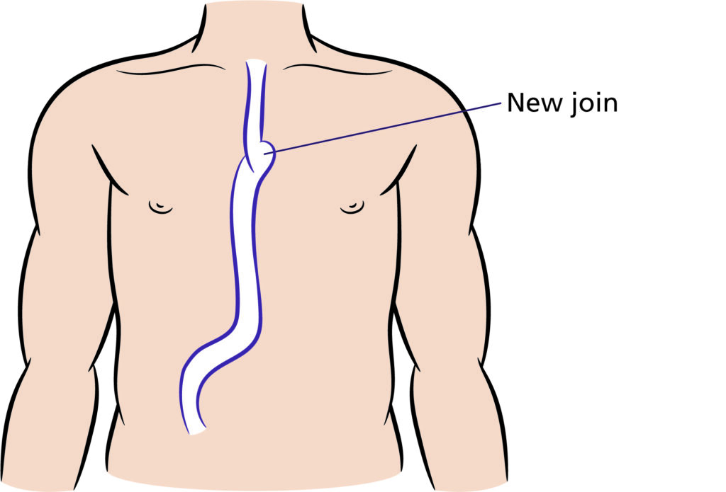 Figure C. 
Illustration that shows new anatomy following Oesophagectomy including the new join.