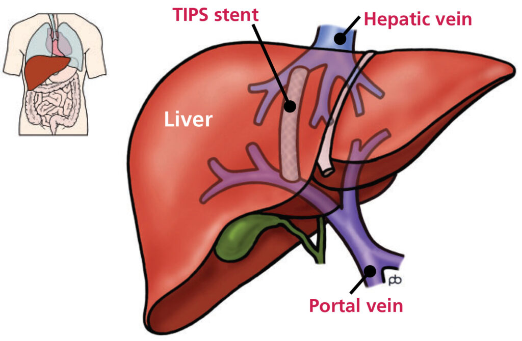 Two illustrations.



The first illustration shows the location of the liver in the human body. 



The second illustration shows a close up view of the liver with a TIPS stent in place, creating an internal 'bypass' between the portal vein and the veins draining blood from the liver back to the heart (the hepatic veins).