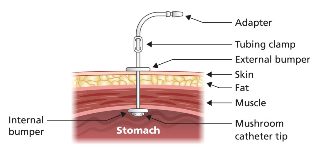 Illustration showing a Percutaneous Endoscopic Gastrostomy tube in place.