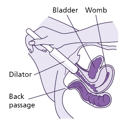 Anatomical illustration showing a cross section of the lower body with the dilator being inserted into the vagina.