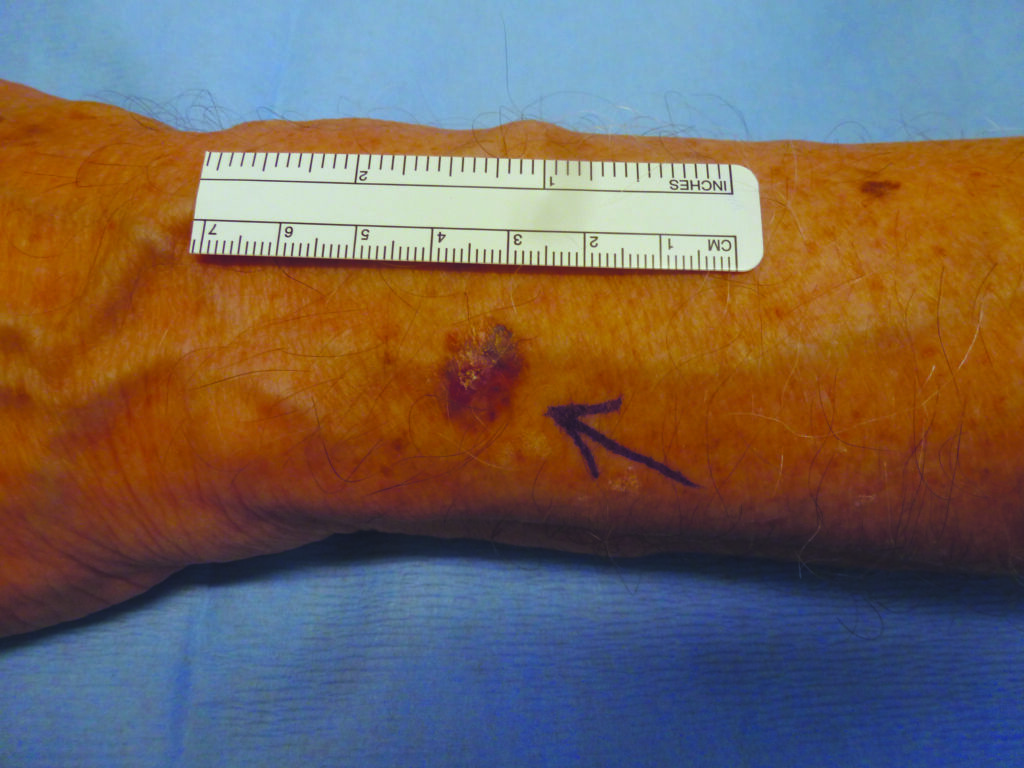 Close up photo of a lesion